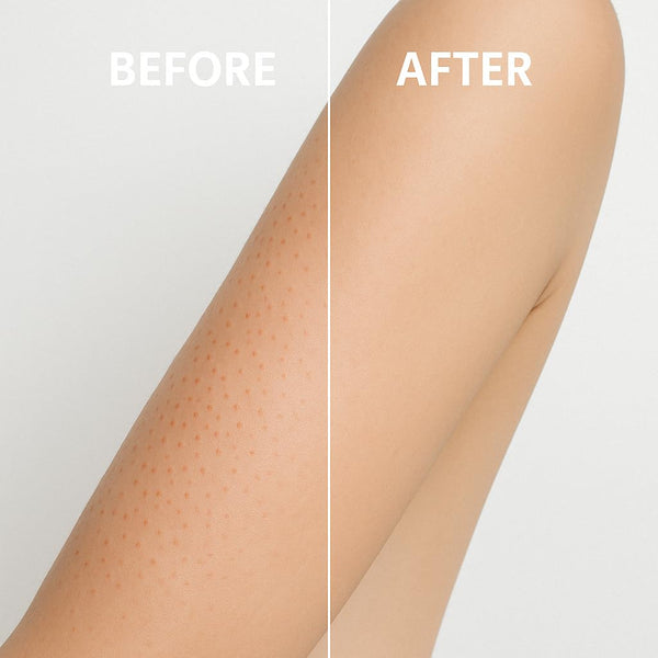 Microdermabrasion Keratosis Pilaris & Acne Exfoliating Deep Cleansing Face & Body Scrub